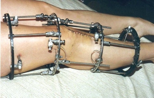 Purportedly first fashioned out of old bike parts, Ilizarov's device could be used to lengthen uneven legs or set unusually complicated fractures. In the case of the former, the limb is deliberately fractured and then stretched millimeter by millimeter with the newly inserted apparatus. To this day, the device is still one of the most common ways to lengthen limbs.