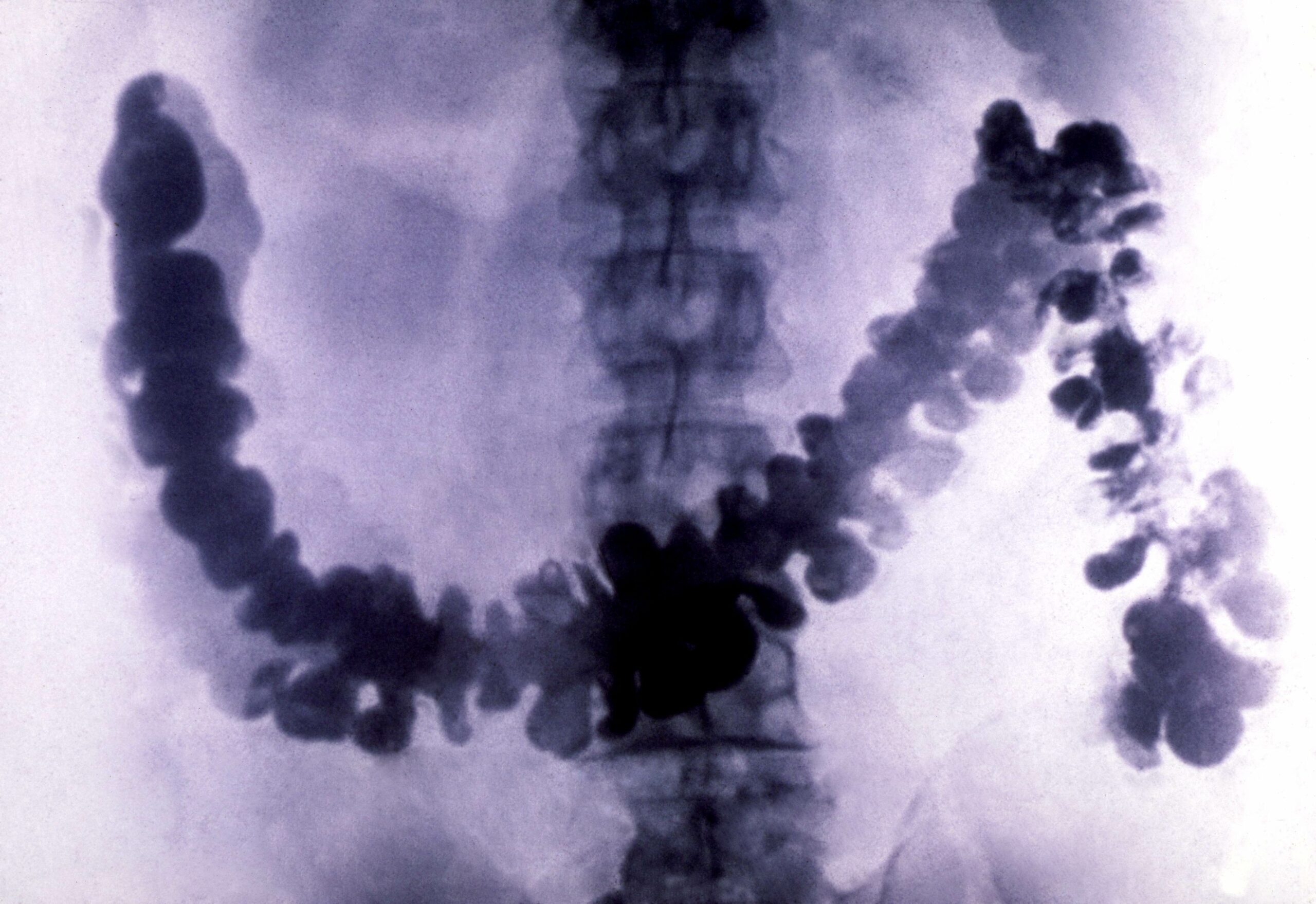 Colon and rectal cancer seem to be on the rise—in millennials