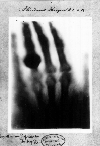 First medical x-ray RÓ§ntgen