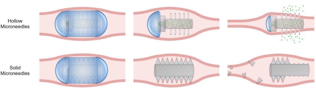 The needles can be hollow, delivering the drug as the gut squeezes (top,) or solid, breaking off along the way to lodge in the tract and squirt healthful chemicals (bottom.)