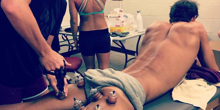 Cupping At The Olympics: Is It A Fad?