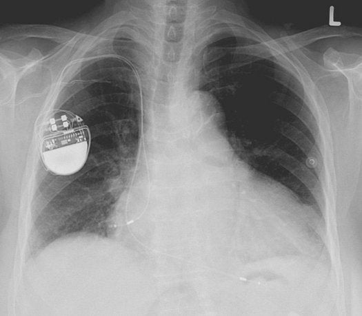 <strong>The hack</strong> Pacemaker-hacking feels like a Hollywood plot. Assassinate someone by taking over the medical device that controls his heart? Surely that isn't possible in the real world. Actually, it's totally possible. Last year, a researcher demonstrated <a href="https://www.popsci.com/technology/article/2012-10/hacker-attackers-could-reverse-pacemakers-distance-delivering-deadly-shocks/">a pacemaker hack in Australia</a>, with a virus that could conceivably spread from one person to every electronically assisted heart within 30 feet. <strong>The threat level</strong> Probably limited to assassination targets. Think: high-profile people, who have pacemakers. It would be an elaborate attack, though, since you need more than just an internet connection to pull it off. Odds are that anyone interested in doing this could get a bomb or a pistol to the target cheaper and faster. This is Hollywood not because it's impossible, but because it's not very efficient.