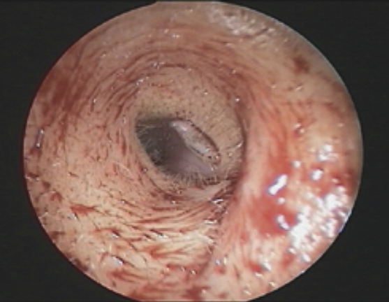 larvae in ear canal
