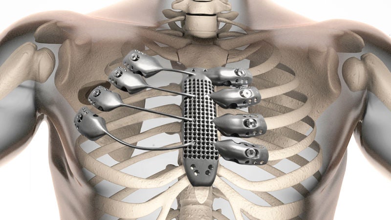 A 54-year-old Spanish cancer patient recently became the world's first person to receive a <a href="http://csironewsblog.com/2015/09/11/cancer-patient-receives-3d-printed-ribs-in-world-first-surgery/">3D-printed chest prosthetic</a>. His custom-designed, titanium sternum and rib cage replacement was printed on a $1.3 million <a href="http://www.arcam.com/?gclid=CL2Aio6H78cCFYM9aQod2ycCIw">electron beam Arcam 3D printer</a>. The operation was a success--just 12 days after his final surgery, the patient was discharged and has recovered well.