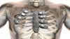 A 54-year-old Spanish cancer patient recently became the world's first person to receive a <a href="http://csironewsblog.com/2015/09/11/cancer-patient-receives-3d-printed-ribs-in-world-first-surgery/">3D-printed chest prosthetic</a>. His custom-designed, titanium sternum and rib cage replacement was printed on a $1.3 million <a href="http://www.arcam.com/?gclid=CL2Aio6H78cCFYM9aQod2ycCIw">electron beam Arcam 3D printer</a>. The operation was a success--just 12 days after his final surgery, the patient was discharged and has recovered well.