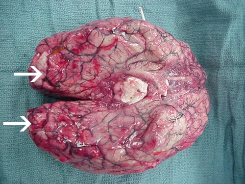Hemorrhaging and Brain Death From Amoeba