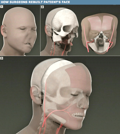 Doctors Perform First-Ever Full Facial Transplant