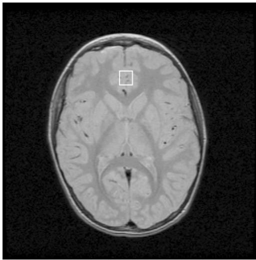 An image of a Magnetic Resonance Spectroscopy brain scan.