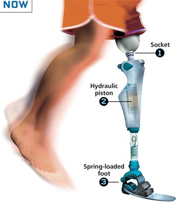 This is the leg that revolutionized prosthetics. Although the C-Leg fits into an often uncomfortable socket [1], it analyzes the user´s gait and speed and continuously adjusts resistance in the hydraulic piston [2]. The foot [3] offers multiaxial rotation and assists, using a coiled spring, in initiating steps. Neither, however, work independently or are able to fully anticipate movement.