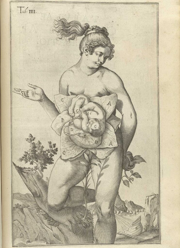 Casseri came from a poor family in Italy, and worked as a servant to a medical student and to a surgeon before becoming a professor of surgery and anatomy himself. Van de Spiegel was born in Brussels and studied under Casseri. This woman seems just so pleased to show off her Cabbage Patch Fetus.