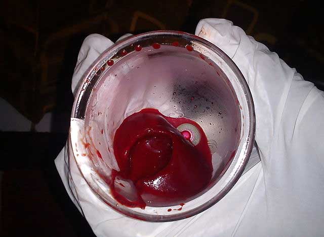 Coagulated blood from a cupping session