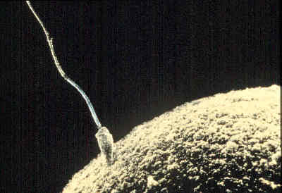 New Procedure Sifts Winners From Losers in a Sample of Sperm