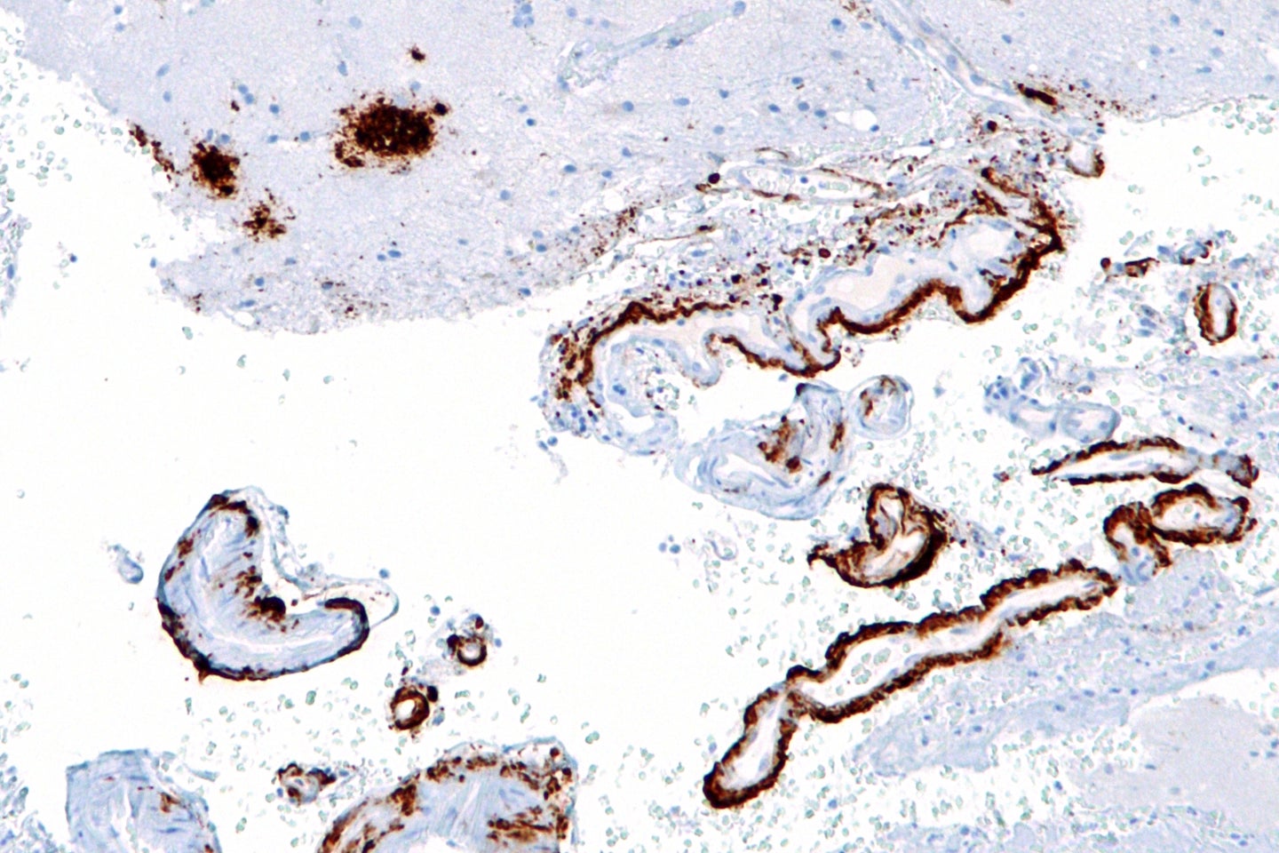 This micrograph shows a buildup of beta amyloid proteins, brown, in a patient's cortex.