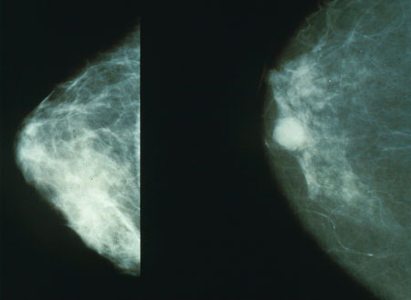 These mammogram images show a healthy breast, left, and a breast with cancer, right.