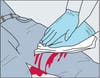 illustrated medic putting pressure on a bleeding wound