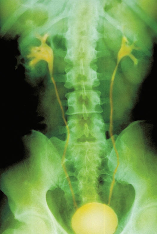Color enhanced normal intravenous pyelogram (IVP), a x-ray which displays the drainage of urine from the kidneys through the ureters towards the bladder. Seen here are the kidneys, ureters, and rounded thick walled bladder in a 22 year old male.