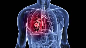 Convincing Lung Cancer To Commit Suicide