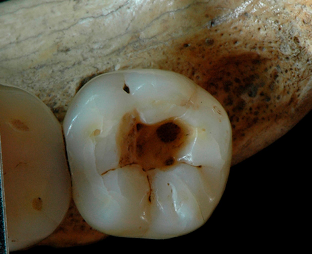People Were Treating Cavities 14,000 Years Ago–And It Wasn’t Pretty