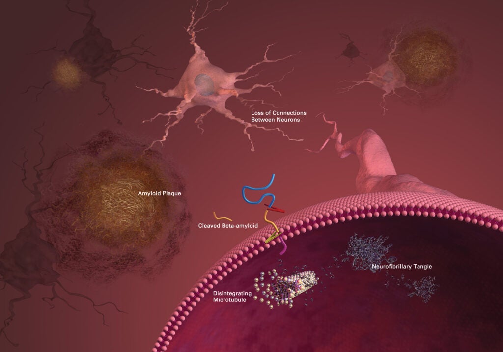 Alzheimer's Neuron