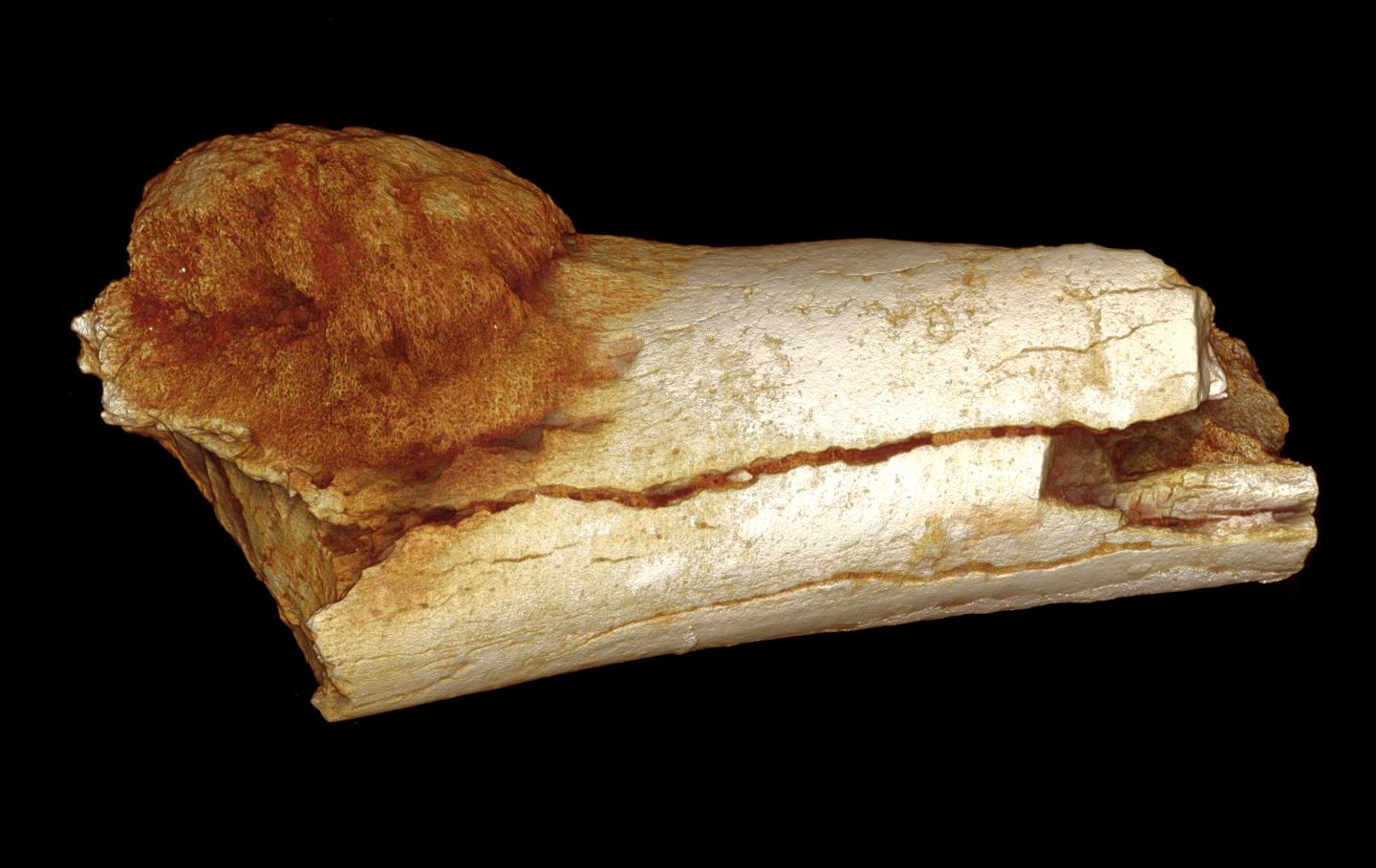 Tumor In Ancient Foot Bone Suggests Paleo Diet Overrated