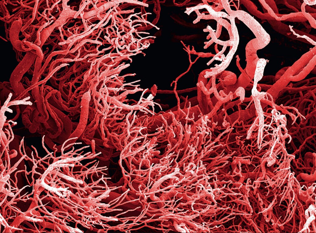 Tumors, uncontrolled tissue growths, come complete with their own sets of blood vessels. These blood vessels found in intestinal tumors are formed irregularly, rather than the uniform fashion of normal intestinal blood vessels.