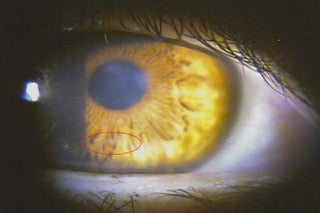 an eyeball with a worm inside
