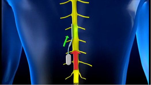 Implant Uses A Microchip Embedded in the Spine To Edit Out Chronic Pain