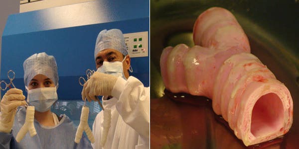 Using a Lab-Grown Trachea, Surgeons Conduct the World’s First Synthetic Organ Transplant