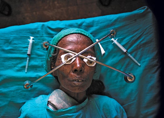 In this Feb. 13, 2010 photograph, Raj Kaliya Dhanuk lies still on a bed with weights on her eyes after receiving local anesthesia at Hetauda community eye hospital in Hetauda, about 40 kilometers (18 miles) south of Katmandu, Nepal. Dhanuk and more than 500 others, most of whom have never seen a doctor before, have traveled for days by bicycle, motorbike, bus and even on their relatives' backs to reach Dr. Sanduk Ruit's mobile eye camp. Nepalese master surgeon Ruit estimates sight has been restored to 3-4 million people through his assembly-line approach. Once condemned by the international medical community as unthinkable and reckless, this mass surgery 'in the bush' started spreading from Nepal to poor countries worldwide nearly two decades ago.