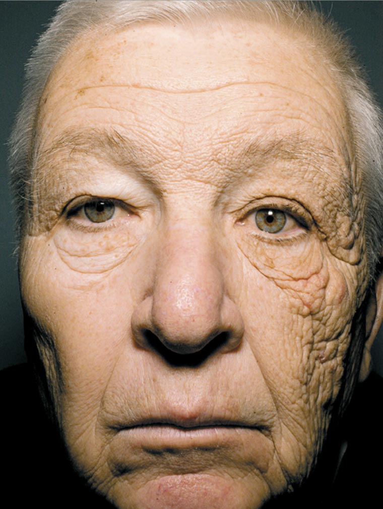 This guy is a truck driver, 69 years old, who's been exposed to 25 years of direct sunlight thanks to his job--but only on the left side of his face. So we get a first-hand view at how much more aged human skin looks when bombarded with sunlight over the years. Crazy. [via <a href="http://gizmodo.com/5914862/shocking-proof-of-how-the-sun-makes-you-age-prematurely">Gizmodo</a>]