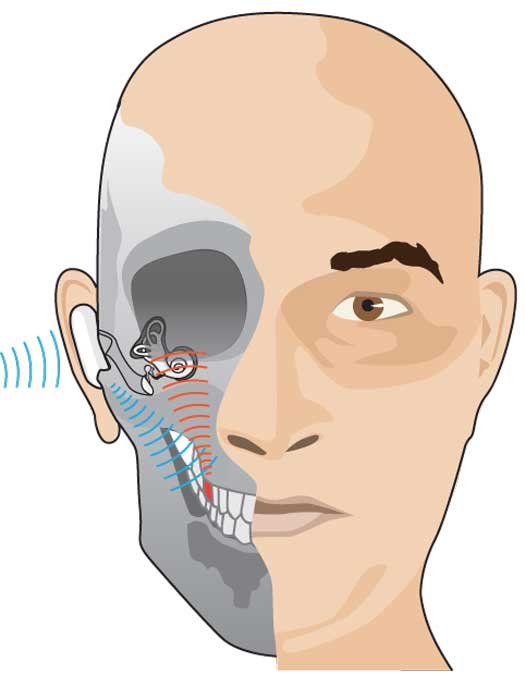 A microphone in the deaf ear beams incoming sound to a receiver on the acrylic tooth insert (placed on either side), which transmits it through the jaw to the cochlea.