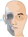 A microphone in the deaf ear beams incoming sound to a receiver on the acrylic tooth insert (placed on either side), which transmits it through the jaw to the cochlea.