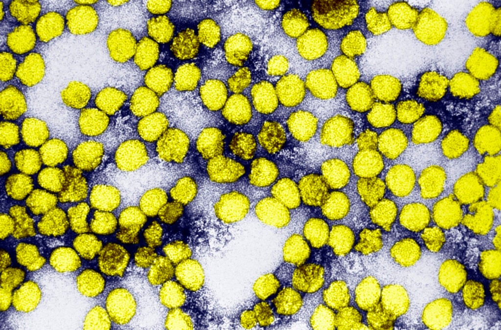 An Electron Micrograph Of Yellow Fever Virus Virions. Virions Are Spheroidal, Uniform In Shape And Are 40 60Nm In Diameter. The Name "Yellow Fever" Is Due To The Ensuing Jaundice That Affects Some Patients. The Vector Is The Aedes Aegypti Or Haemagogus Spp. Mosquito. (Photo By BSIP/UIG Via Getty Images)