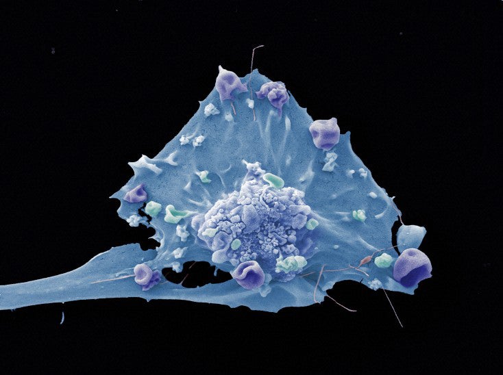 Color-enhanced shot of a breast cancer cell