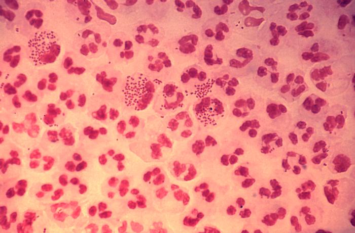 Newly Found Gonorrhea Superbug Resists All Existing Antibiotics
