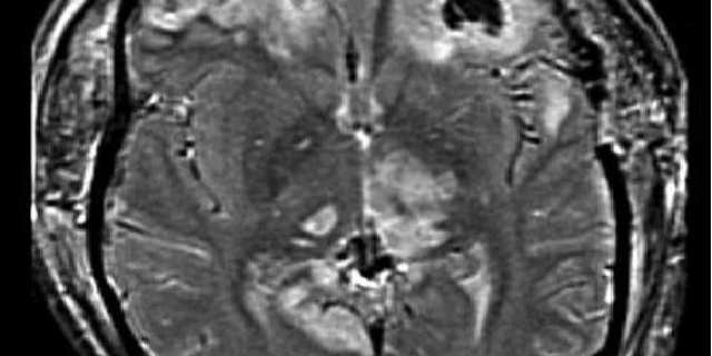 A Squirt of Stem Cell Gel Heals Brain Injuries