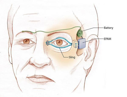 First Artificial Muscles Used to Control Eyelids