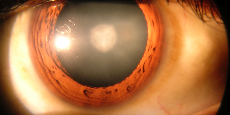 Stem Cells Can Regenerate The Lens In Your Eye