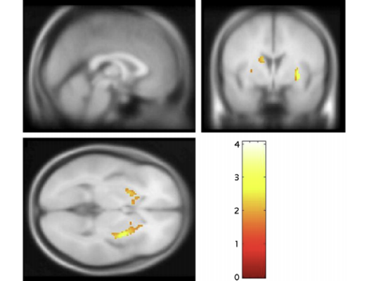 PET scans showed regular cannabis users had a reduction in dopamine synthesis capacity in the striatum compared to non-users.