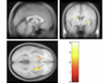 PET scans showed regular cannabis users had a reduction in dopamine synthesis capacity in the striatum compared to non-users.