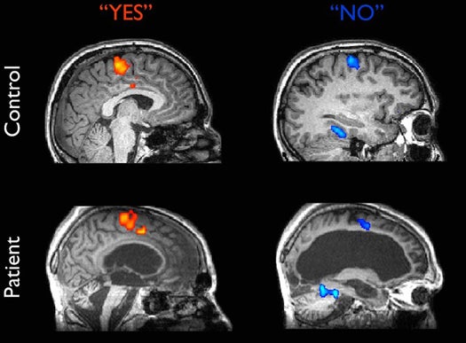 These brain scans show activity in response to a yes or no question. The similarity in activity between the conscious control subject and the supposedly brain dead patient call into question the diagnosis of "vegetative state".