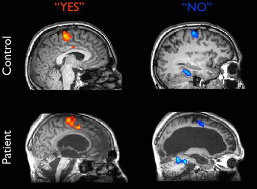 Brain Scan Shows Vegetative Patient Responding To Yes-or-No Questions