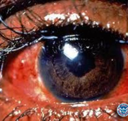 How Counterfeit Contact Lenses Can Make You Go Blind