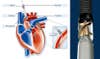 Impella 2.5 Cardiac Assist Device