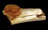This foot bone dates back around 1.7 million years and contains a large, malignant tumor.
