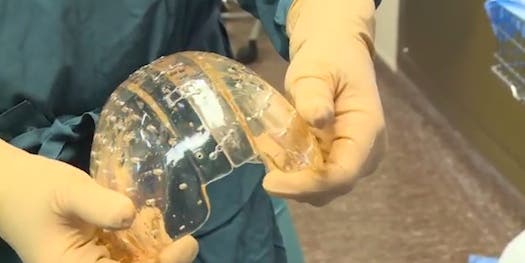 Woman Has Her Skull Replaced With A 3-D-Printed Plastic One