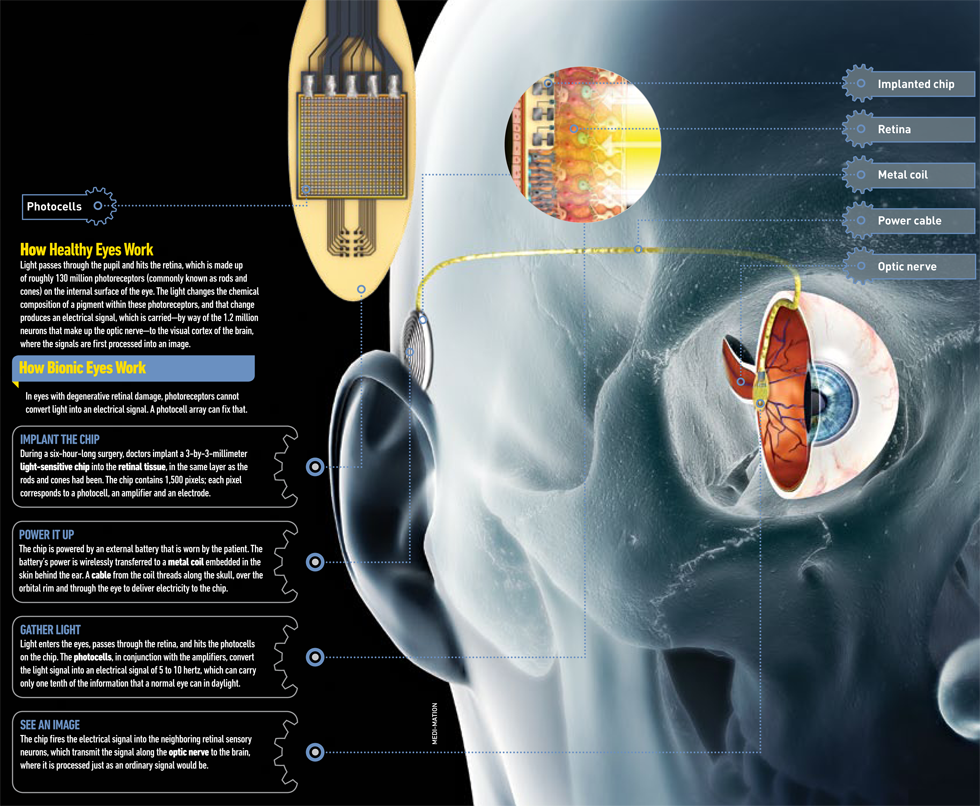 How It Works: An Implantable Bionic Eye