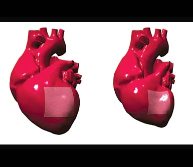 Researchers at MIT are devising a bandage made with living heart cells. After a heart attack, it will contract along with the rest of the heart, replacing damaged tissue.