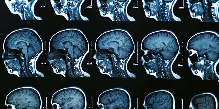Concussions make lasting changes to the brain, even after you feel fine