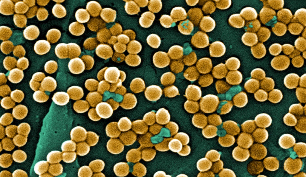 This 2005 colorized scanning electron micrograph (SEM) depicts numerous clumps of methicillin-resistant Staphylococcus aureus (MRSA) bacteria.